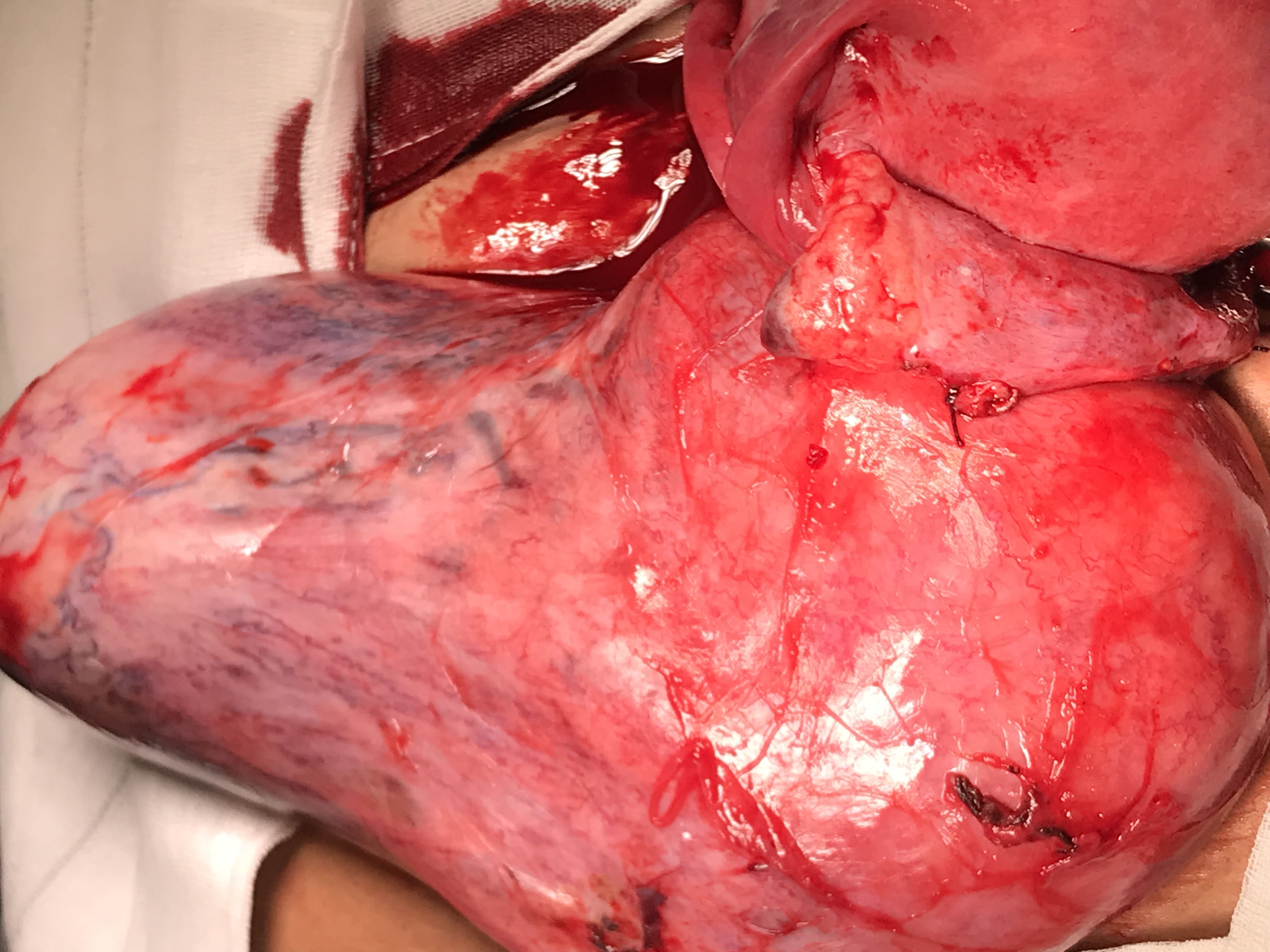 Dr Serag Youssif Fibroid Very Large Herniating Through Pelvic Floor2